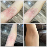 1+1 INGYENES: Prémium STOP ECZEMA gél gyógyító béta-glükánokkal a bőr gyógyulásáért