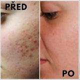 1+1 INGYENES: Prémium STOP ACNE gél problémás és kipirosodott bőrre